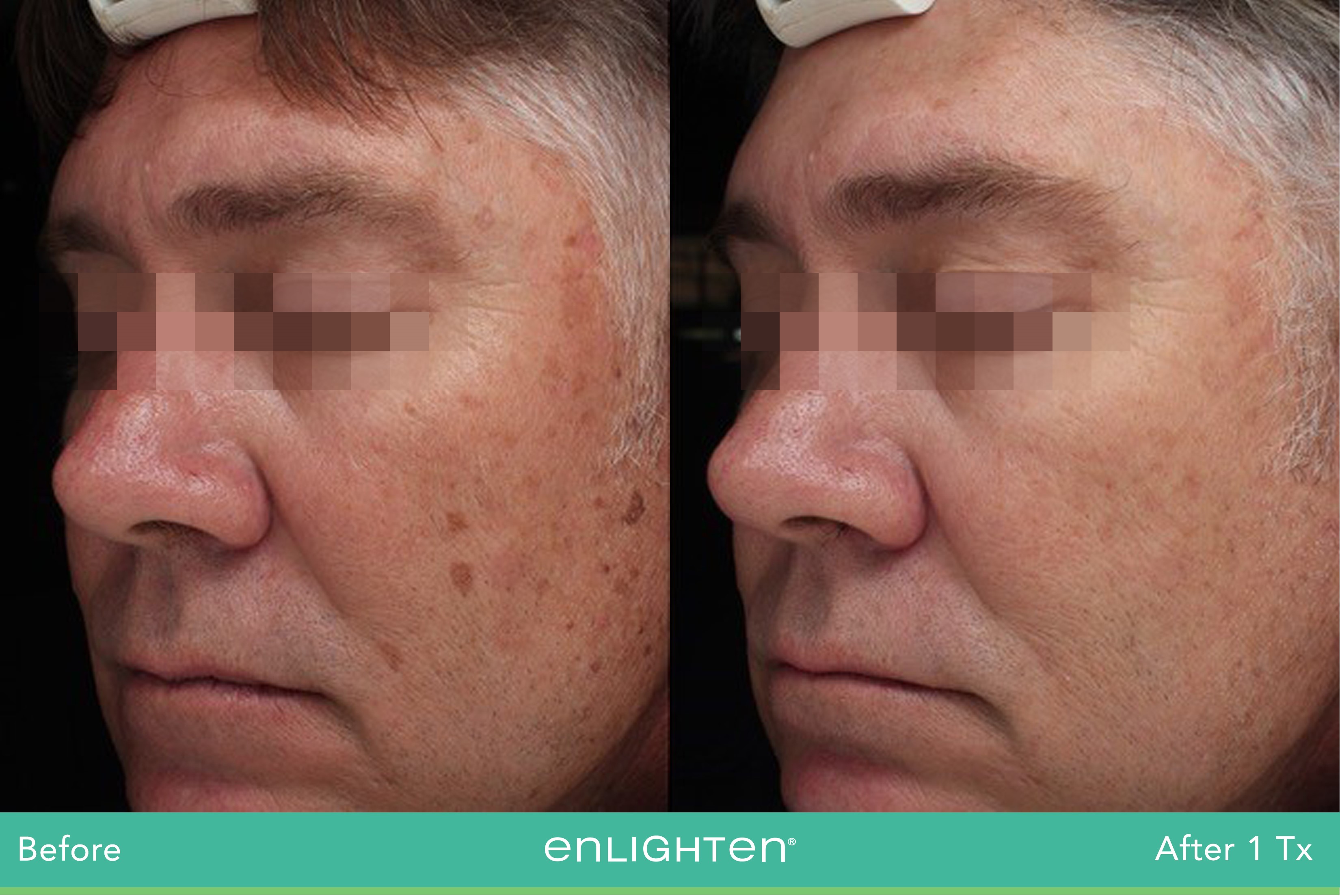 enlighten picogenesis Riekie Smit MD P2 left face highres