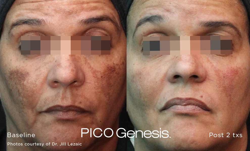 enlighten pico genesis 5