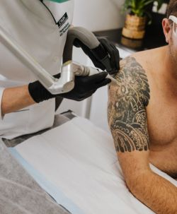 tattoo Laser removal