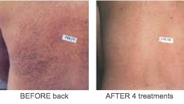 Back Hair Removal Before And After