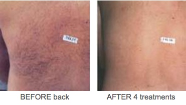 Ipl Skin Treatment Ipl Hair Removal Beauty Salon Toowoomba Ipl