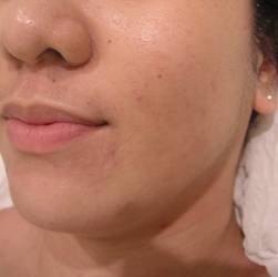 Acne Breakouts Pimples Treatment After