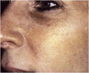 Pigmentation Sun Spots After
