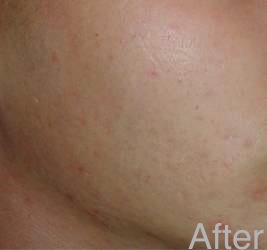 congestion blackheads oily after