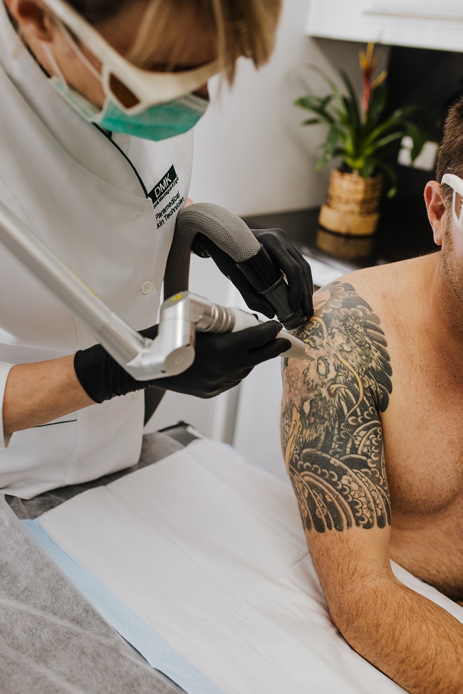 tattoo Laser removal